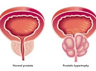 Нормальная и опухшая простата