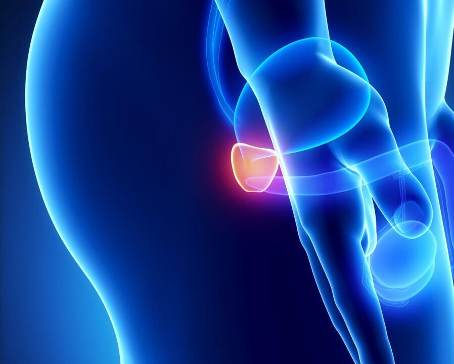 Воспаление предстательной железы.